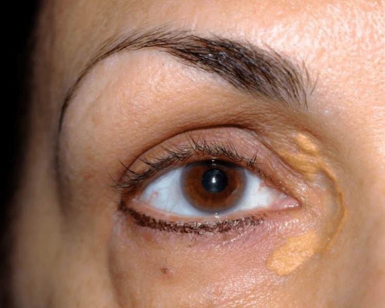 Acupulse - Xantelasma