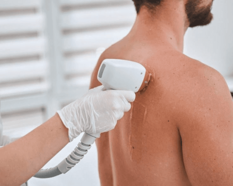 Depi Espalda - PRIMELASE