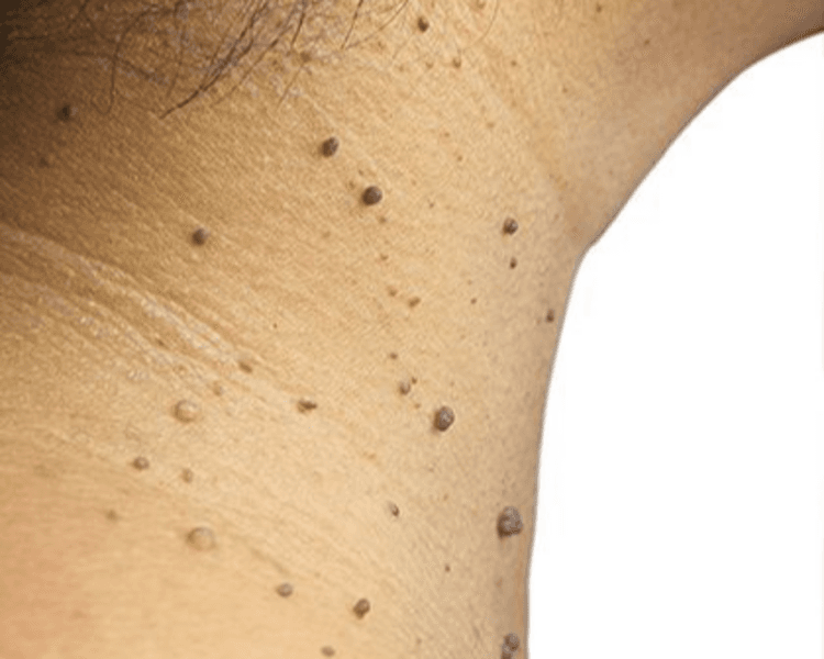 Acupulse - Acrocordones