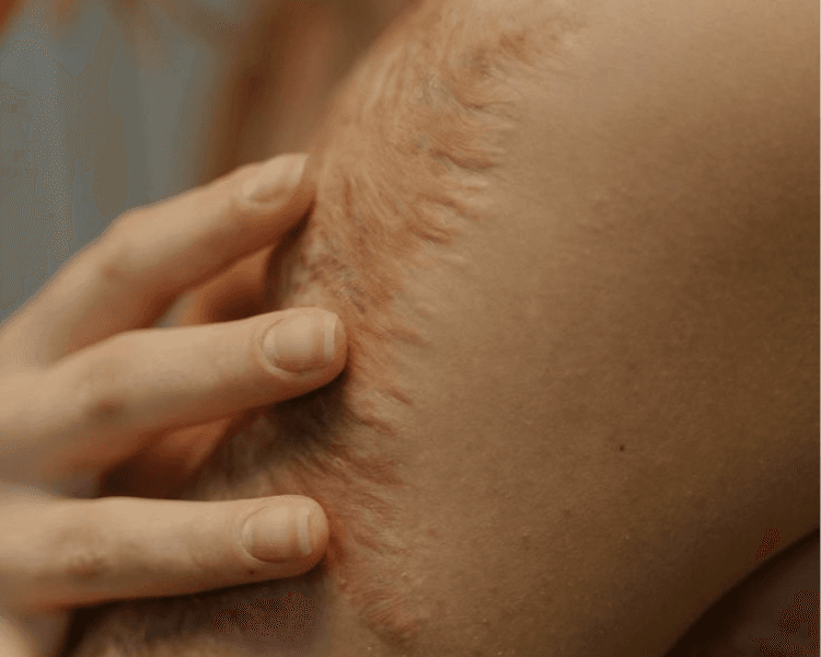 Acupulse - Cicatríz extensa