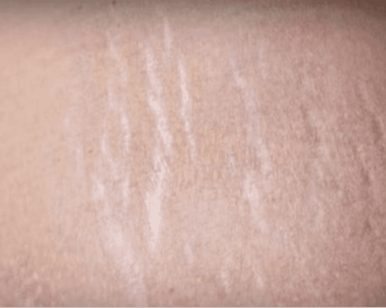 Acupulse - Estrías área grande