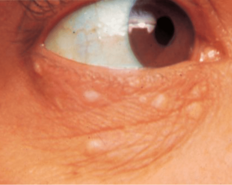 Acupulse - Siringomas