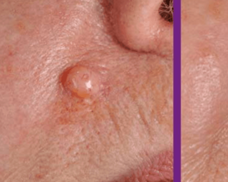 Acupulse - Verrugas / Nevos