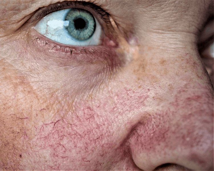 Stellar M22 - Telangiectasias nariz