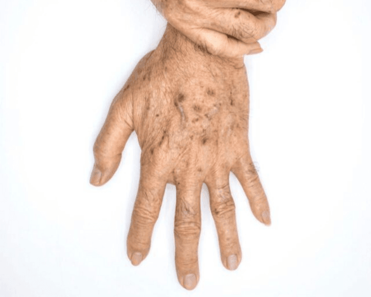 Acupulse - Manos resurfacing fotodaño