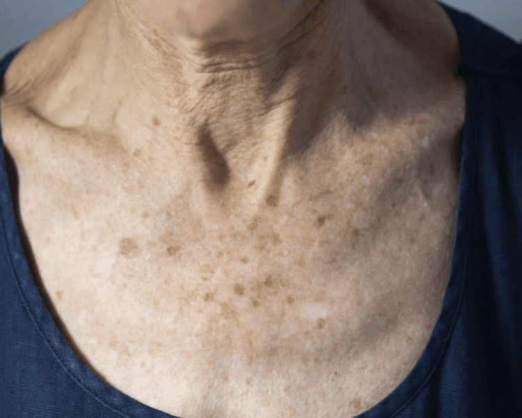 Stellar M22 IPL - Escote