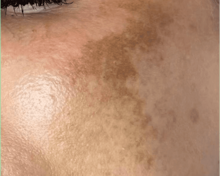 Manchas Melasma, Láser Hollywood Spectra