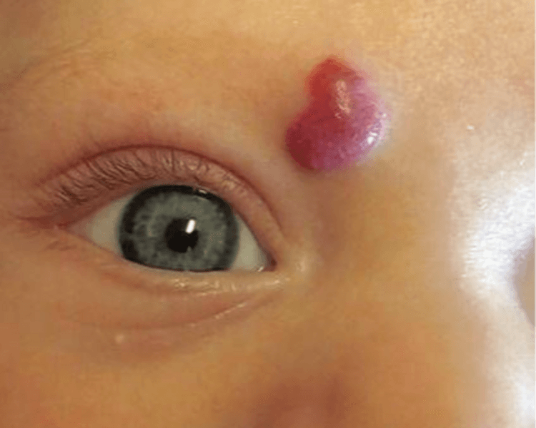 Stellar M22 - Angioma