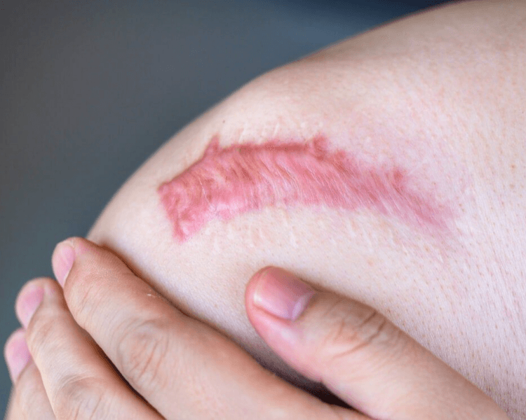 Stellar M22 - Cicatriz hipertrófica o queloide