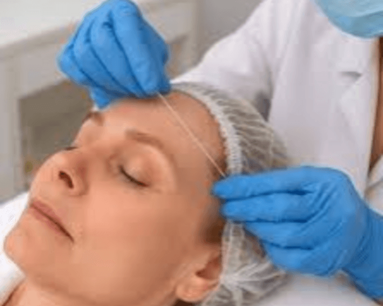 HILOS DE COLAGENO REABSORBIBLES