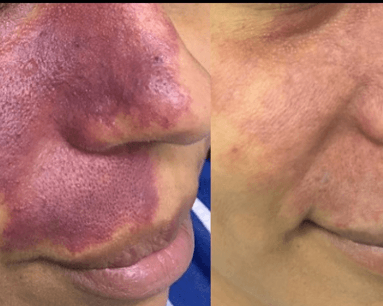 Stellar M22 - Mancha en Vino de oOporto