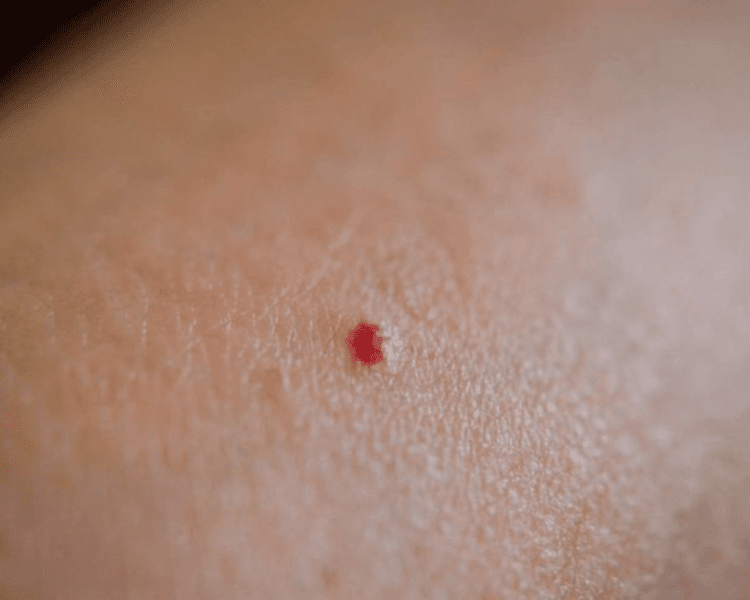 Stellar M22 - Nevo Rubí