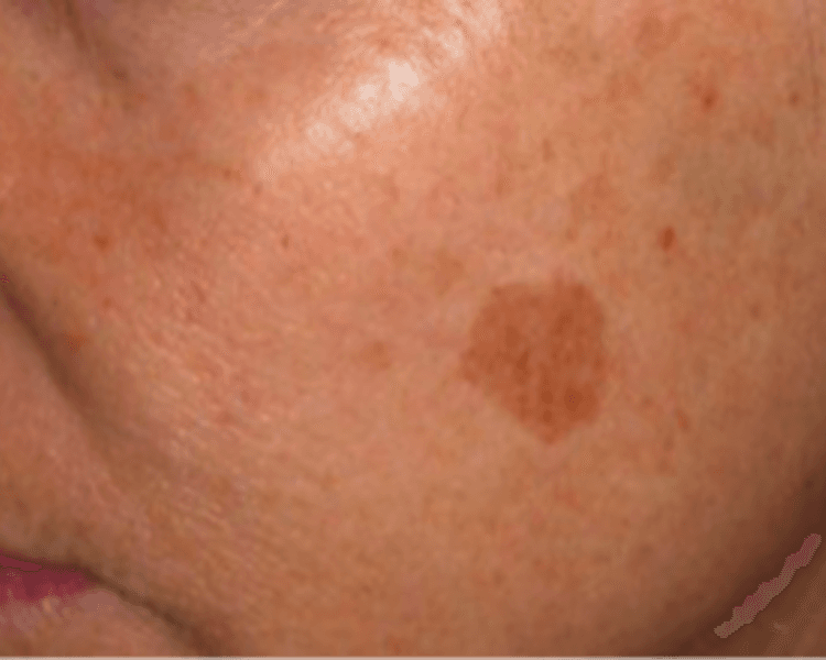 Stellar M22 IPL - Manchas (lentigos - melasma)