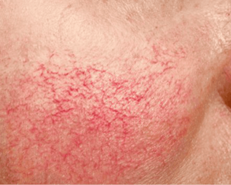 Stellar M22 - Rosácea y Telangiectasias