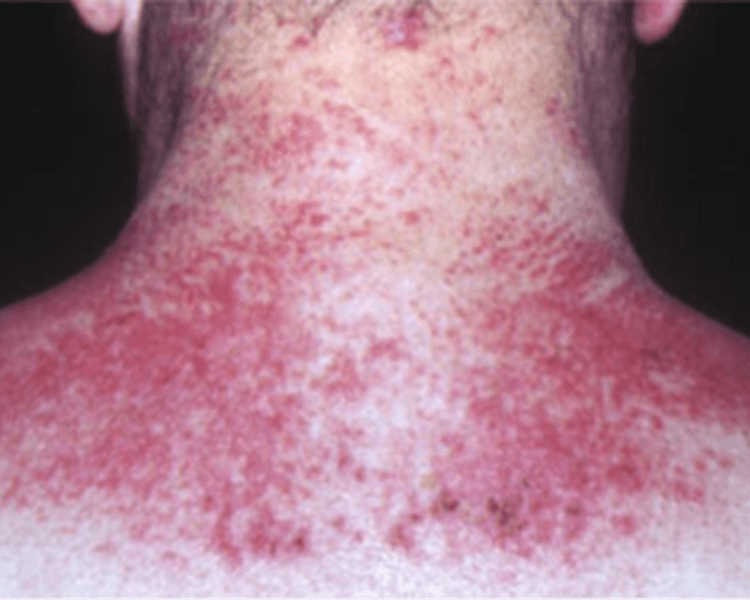 Stellar M22 - Poiquilodermia