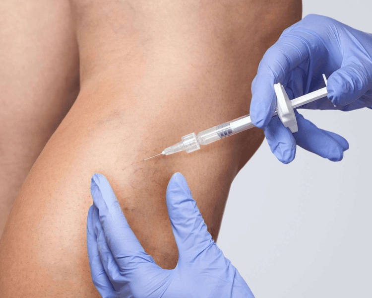 Escleroterapia varículas - con Espuma