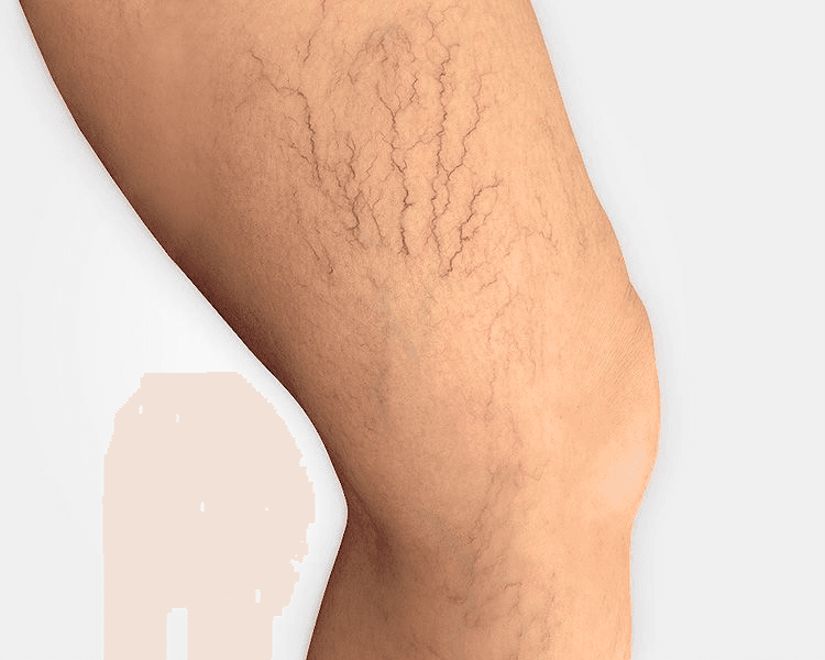 Stellar M22 - Varículas - Láser Nd-Yag