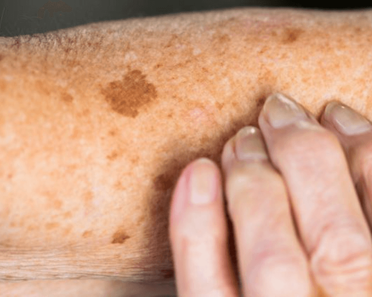 Acupulse - Queratosis seborreica