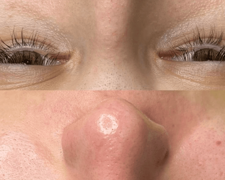 LIMPIEZA FACIAL INICIAL- libre de impurezas y puntos negros