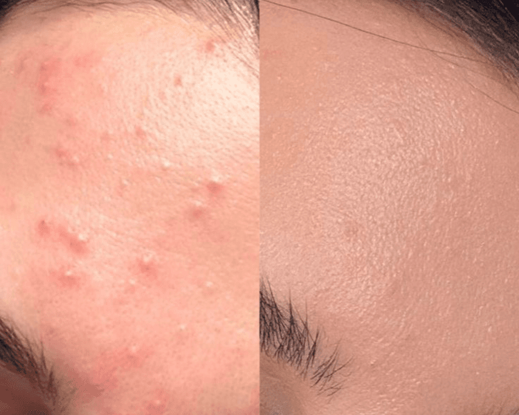 LIMPIEZA FACIAL INICIAL- libre de impurezas y puntos negros