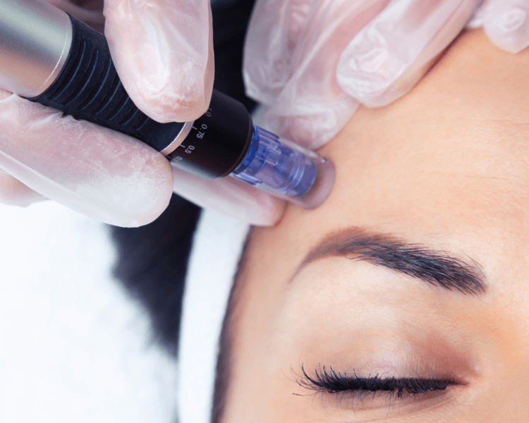 HIGIENE PROFUNDA CON MICRONEEDLING (DERMAPEN)