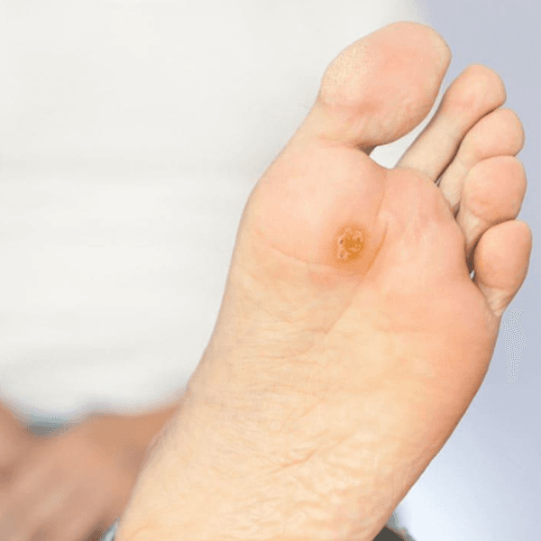 Podología clínica Pie Diabético