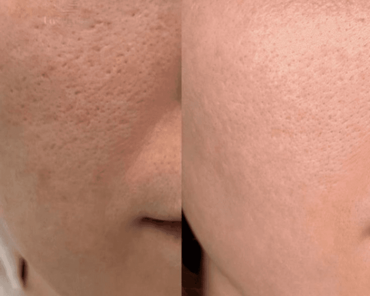 Dermapen