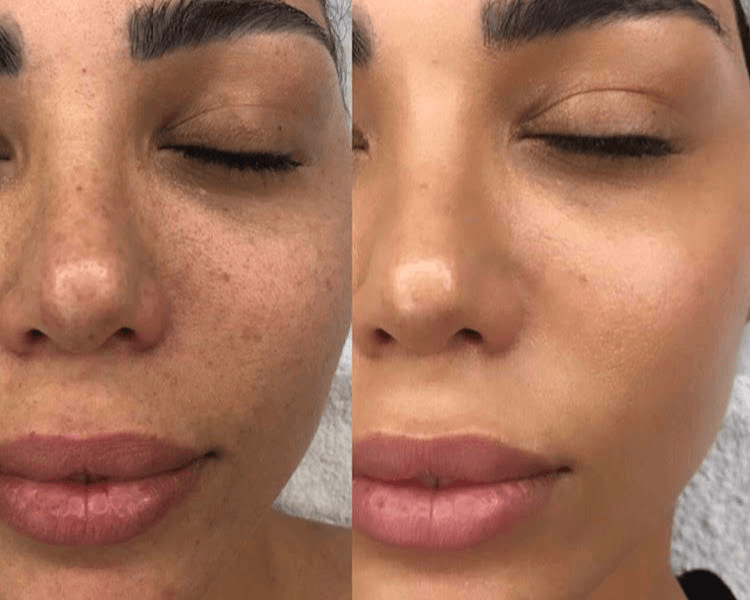 Exosomas faciales