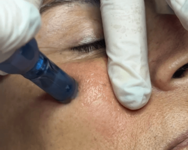 Micropeel (Dermapen)