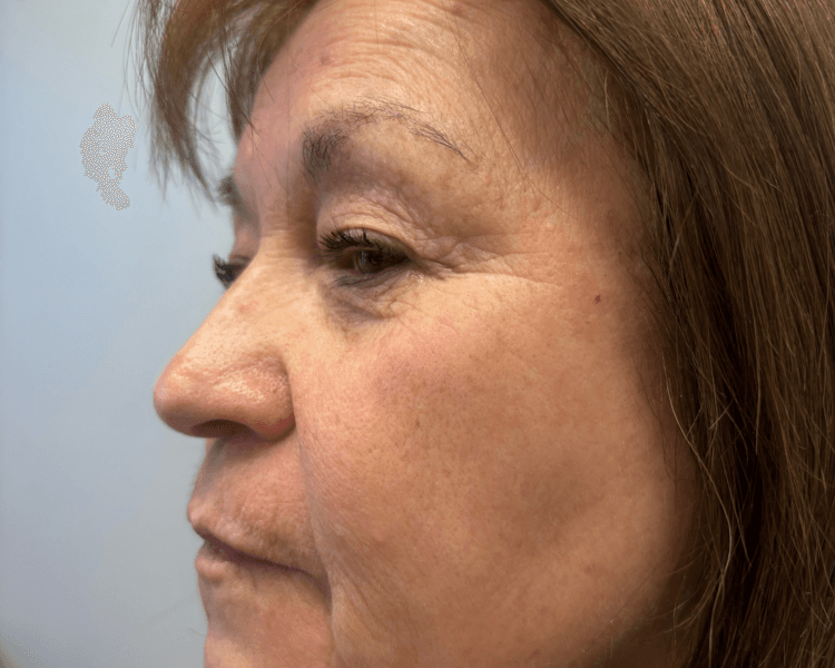 Duo Tensamax Y Dermapen