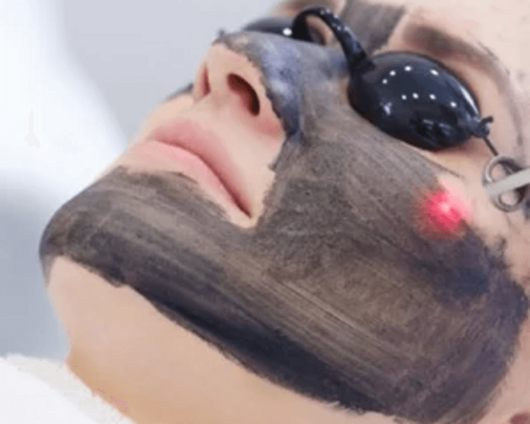 Hollywood peel (laser ND YAG) trionda