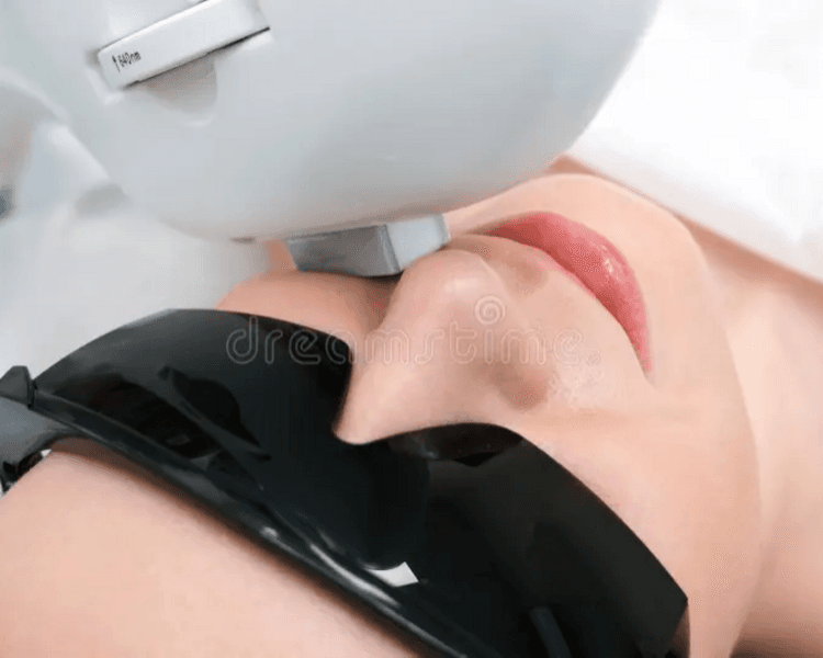 Depilacion laser diodo trionda zonas pequeñas