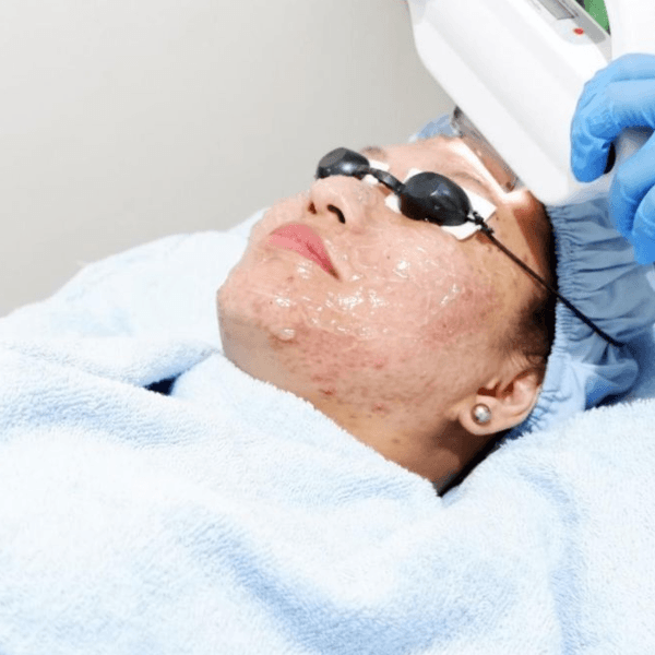 Acne Treatment / Tratamiento Acné