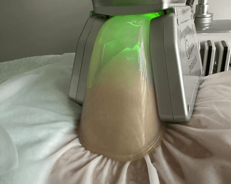 2 Sesiones de Criolipólisis 4 manípulos