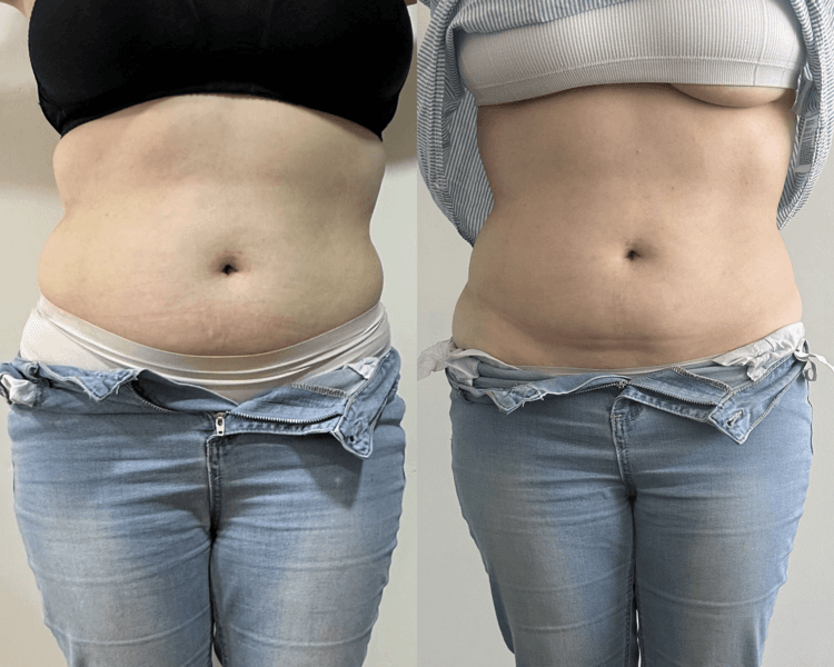 Tratamiento Reductivo Manual