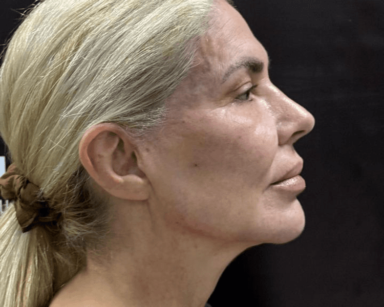 MARCACIÓN MANDIBULAR