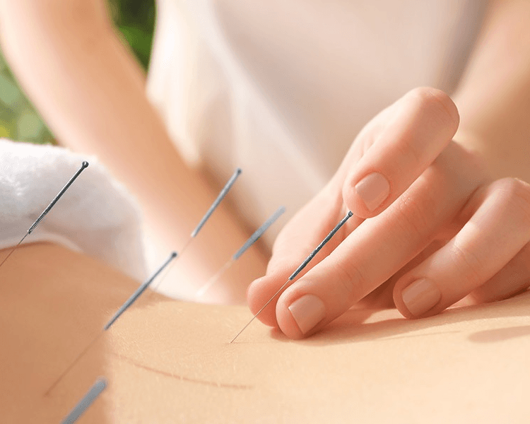 Tratamiento de acupuntura