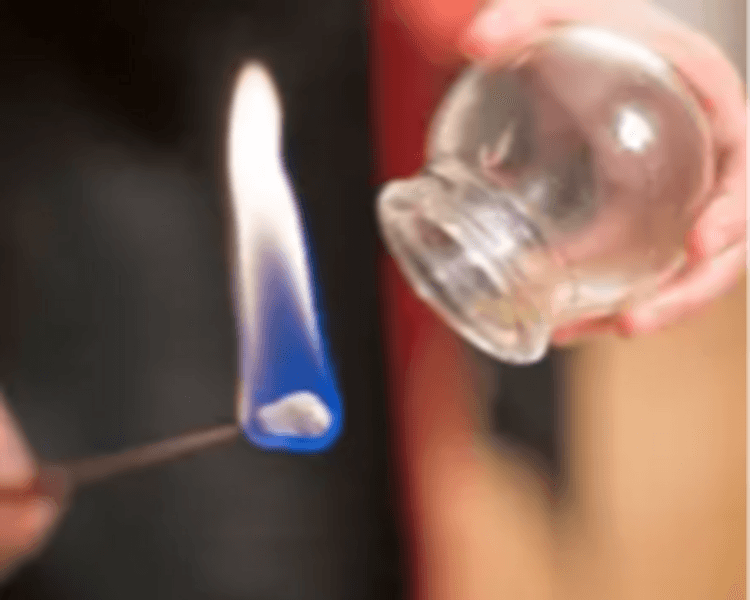 Masaje con ventosas (aliado insuperable para quienes sufren dolores musculares y rigidez)