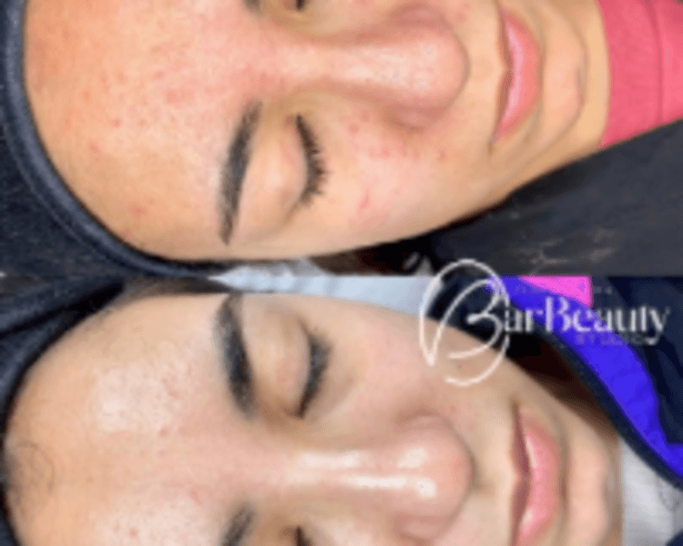 Limpieza Facial Adolescentes