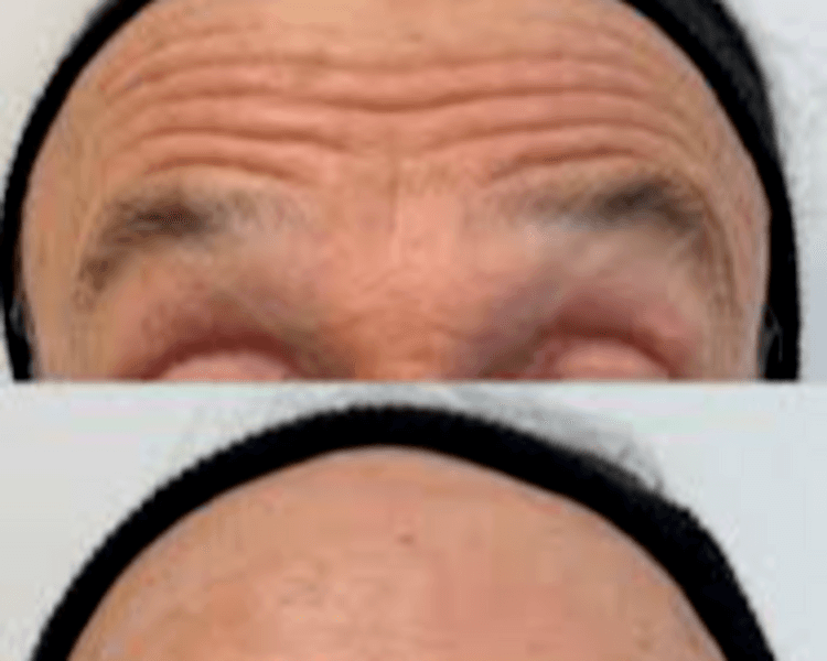 TOXINA TERCIO SUPERIOR XEOMIN/BOTOX