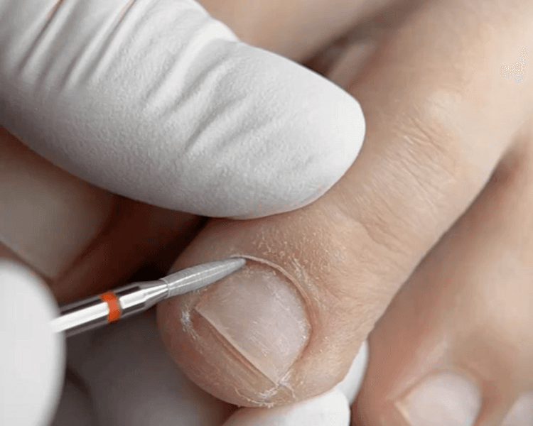 Retiro semipermanente pies