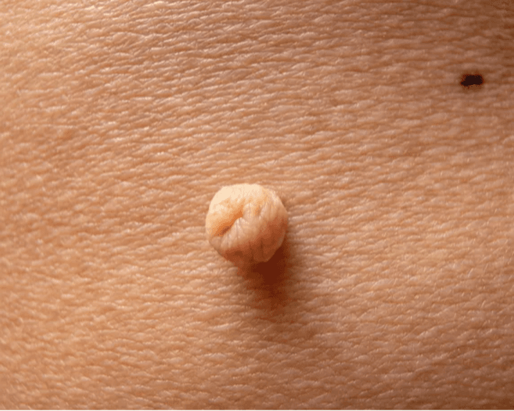 FIBROBLAST TRATAMIENTO VERRUGAS / PAPILOMAS CUTANEOS/ACROCORDONES