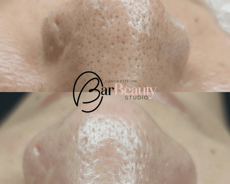 Limpieza Facial Profunda