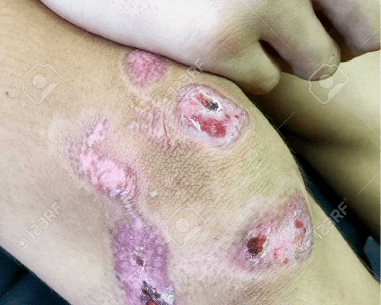 Infiltraciones Perilesionales OZONO ( 10 sesiones)