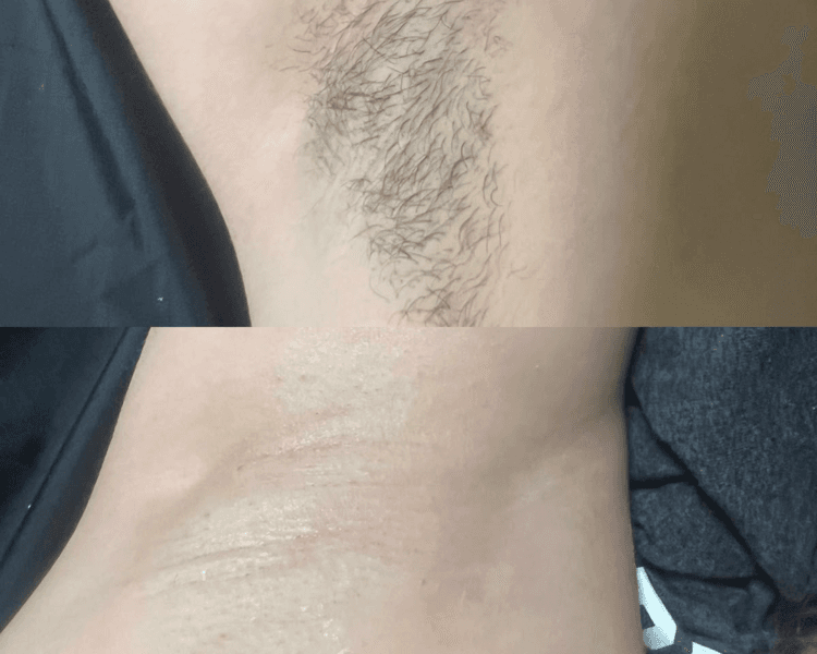 Depilación de axilas