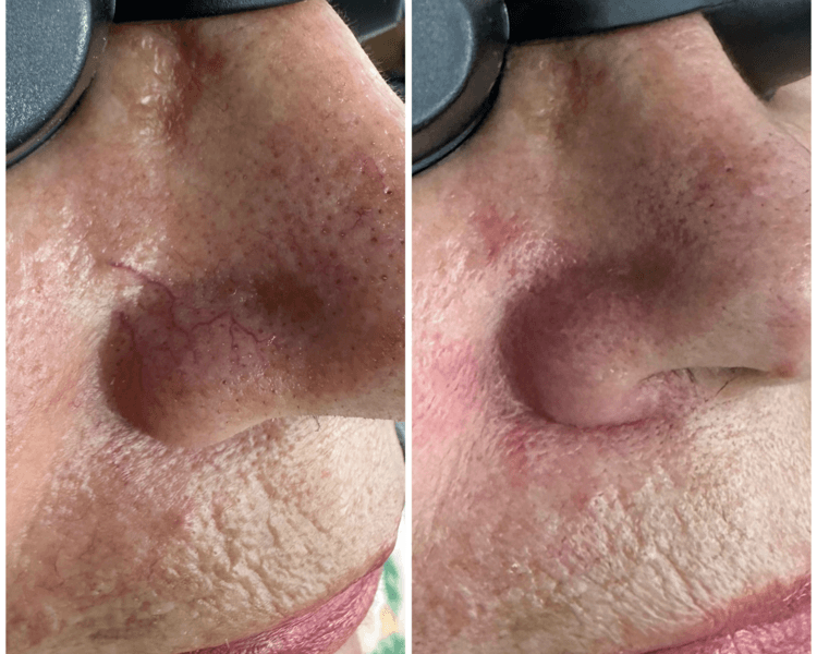 Arañas vasculares (Laser diodo 980) x 1 Cd:1601124