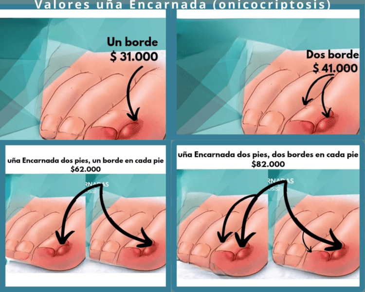 Uña Encarnada Unilateral (un borde)