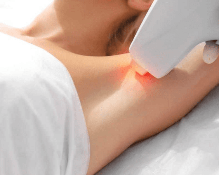 Depilación definitiva luz pulsada