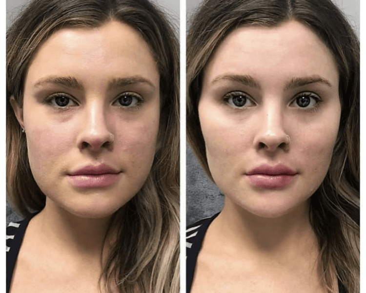 Proyección de Pómulos (2ML Valor exclusivo)