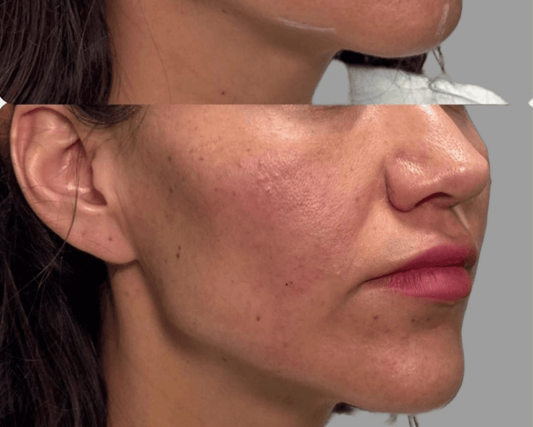 Reborde Mandíbular con Ácido Hialurónico (Valor por ML)